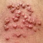 Herpes sinh dục bội nhiễm có nguy hiểm không